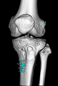 術後3D-CT