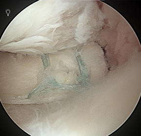 半月板後角断裂に対する骨切り術を併用したプルアウト縫合
