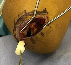 離断性骨軟骨炎によって遊離した軟骨片