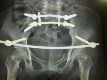 骨折手術2